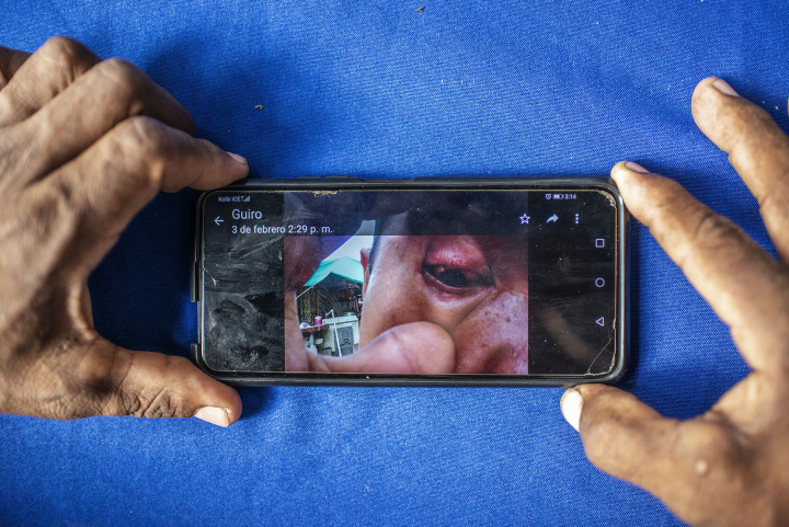 Ein Arbeiter zeigt ein Foto seiner Augen nach Kontakt mit einem Herbizid, das in einer Bananenplantage ausgebracht wurde Ein Arbeiter zeigt ein Foto seiner Augen nach Kontakt mit einem Herbizid, das in einer Bananenplantage ausgebracht wurde