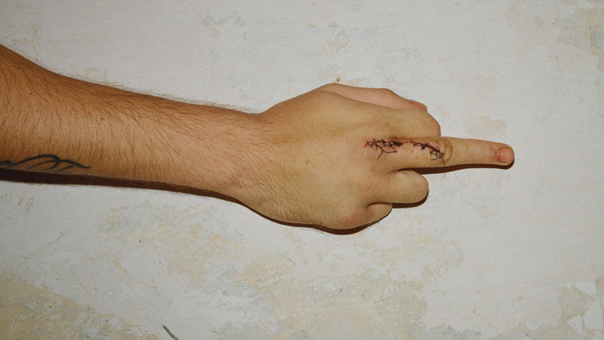 Eine Hand mit genähter Wunde zeigt den Mittelfinger Eine Hand mit genähter Wunde zeigt den Mittelfinger